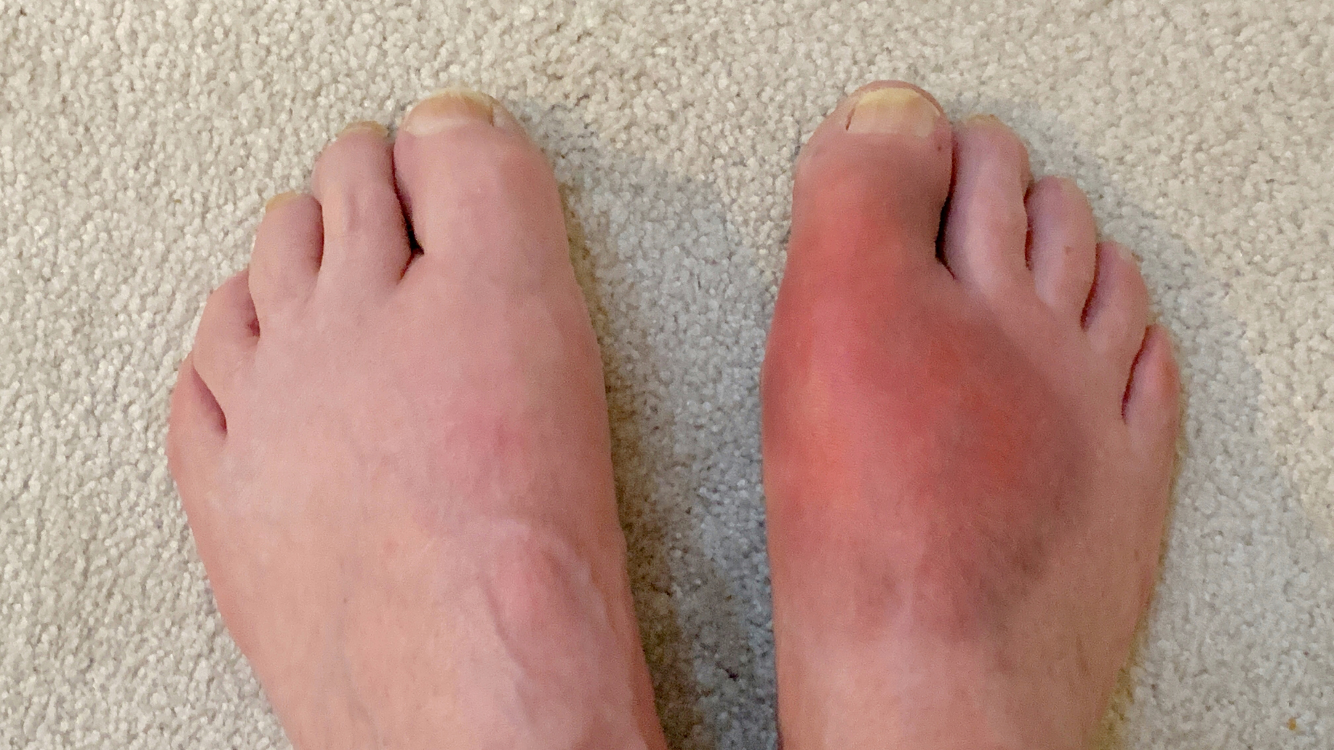 How do you know you have gout?