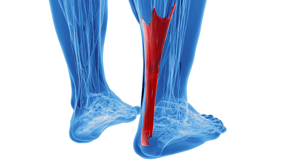 Understanding Achilles Tendonitis: Causes, Symptoms, and Treatment