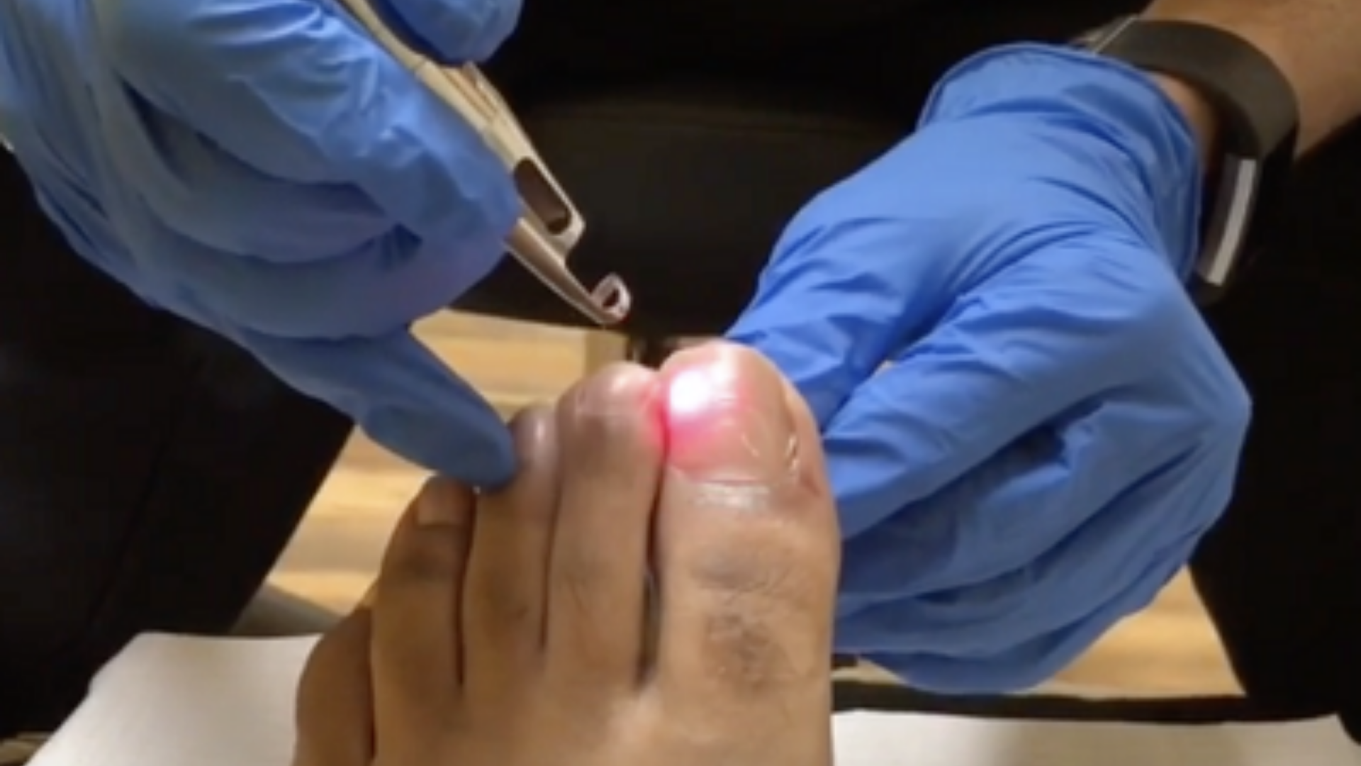 A Modern Solution: Laser Treatment for Toenail Fungus