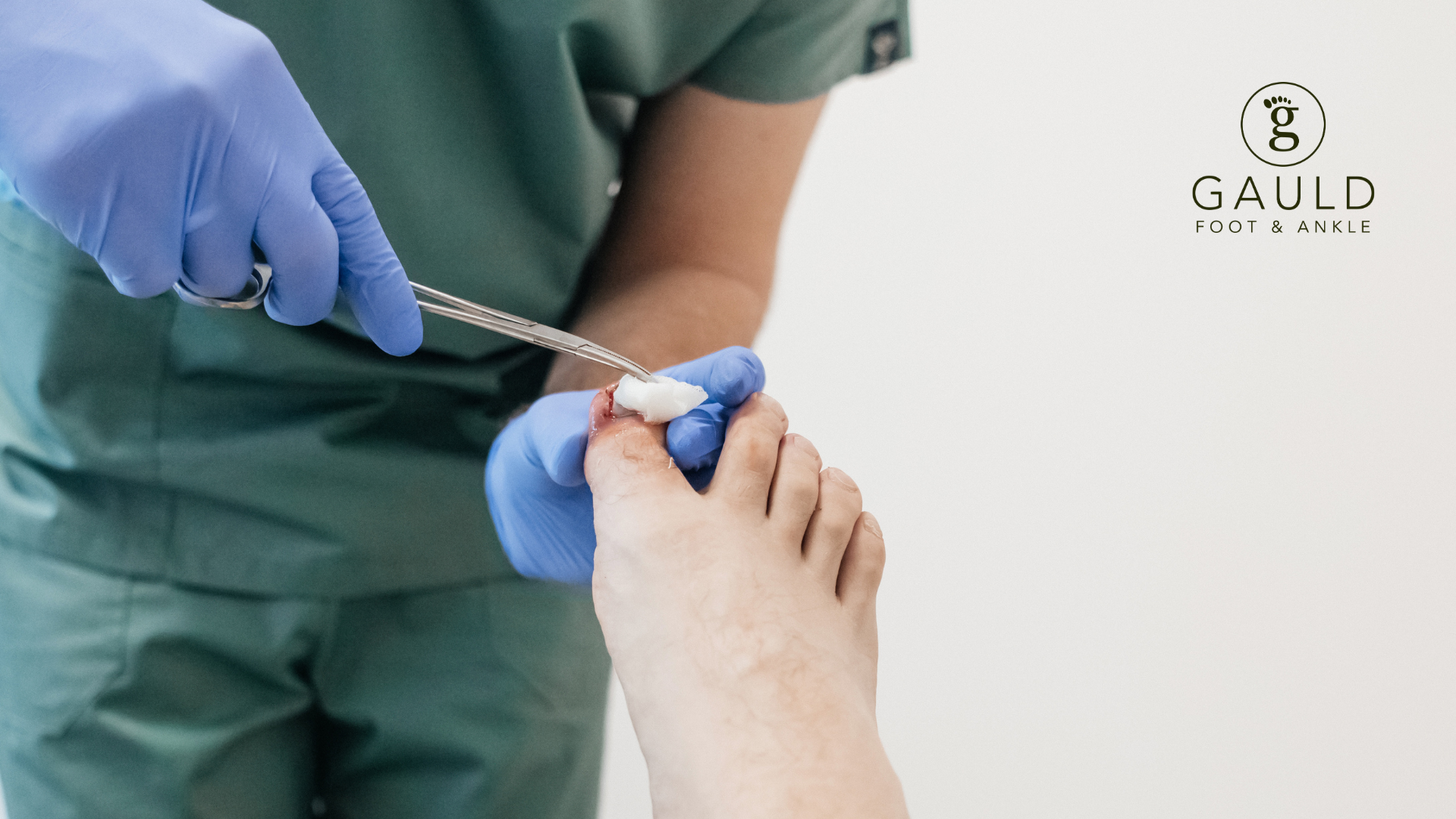 Do Podiatrists Remove Ingrown Toenails? Here’s What You Need to Know