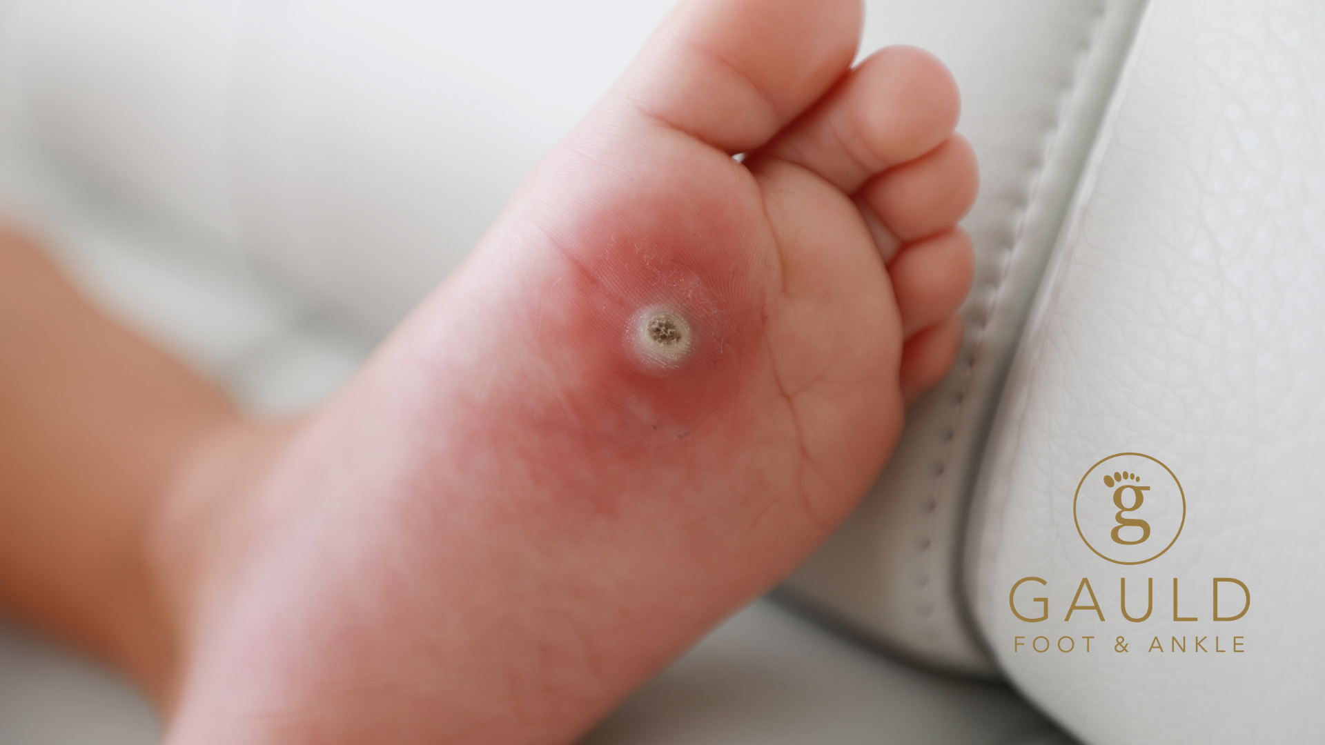Plantar Wart Removal: What to Know and How to Get Lasting Relief