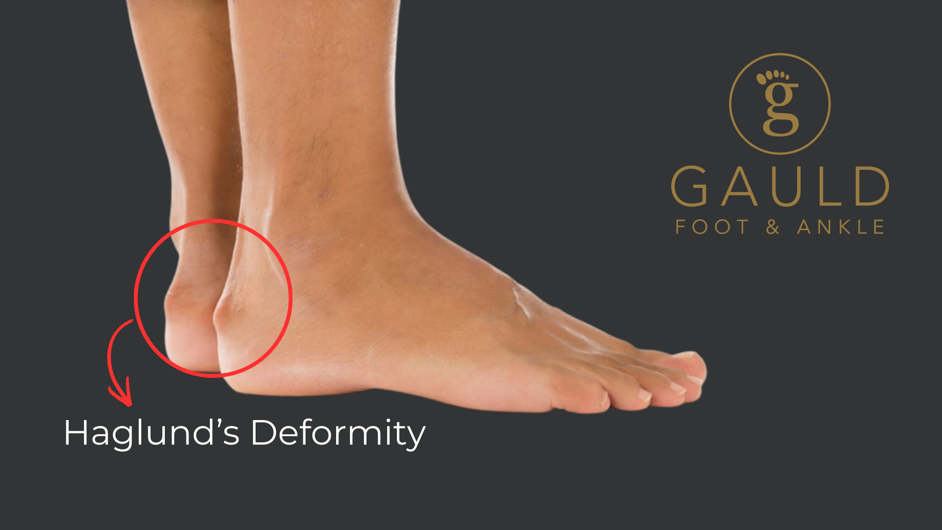 Haglund’s Deformity