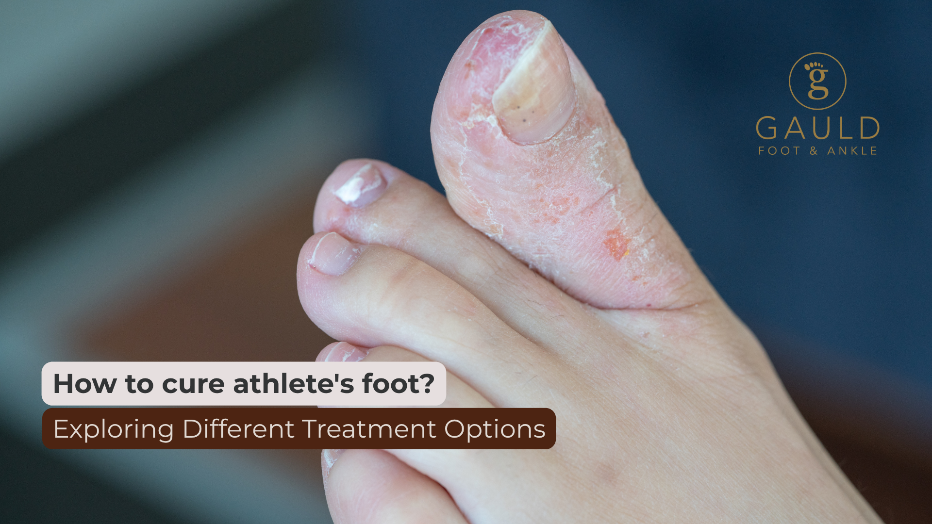 How to cure athlete’s foot? Exploring Different Treatment Options