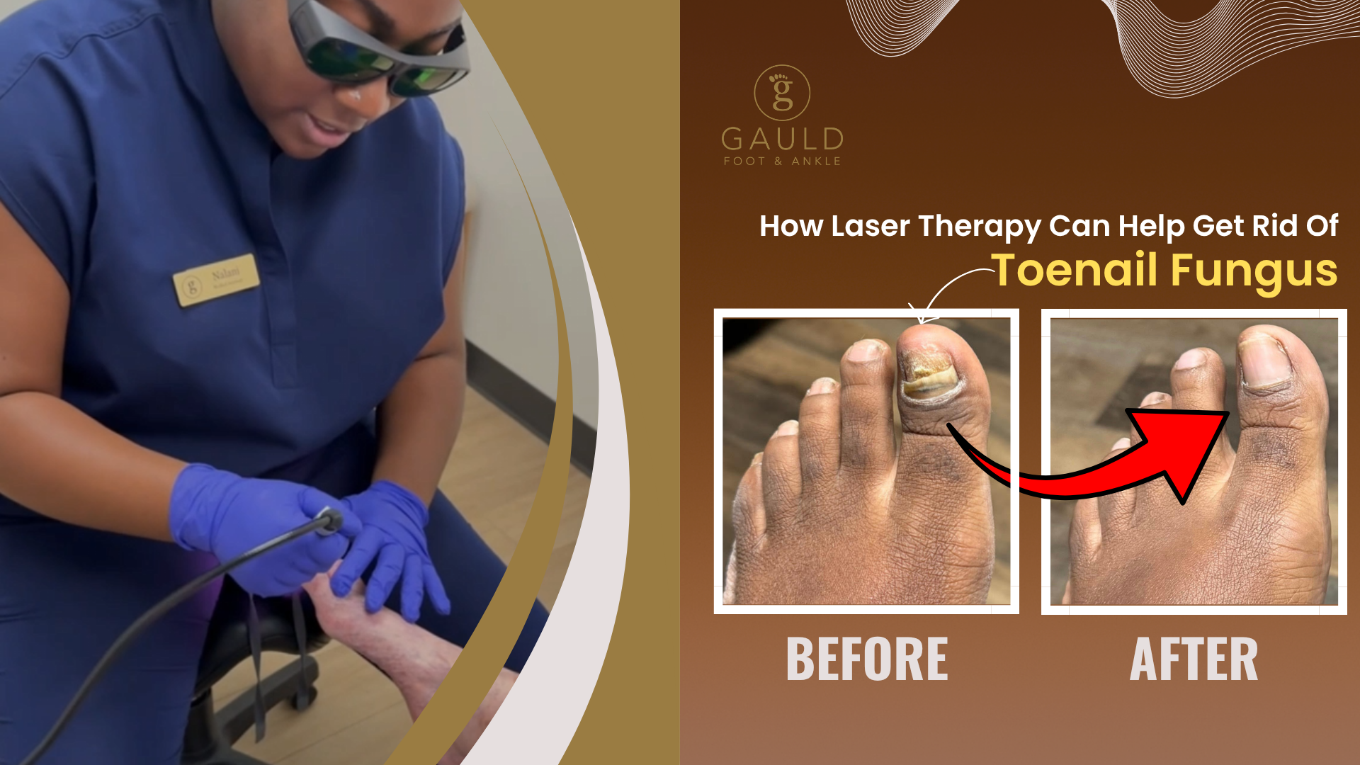laser therapy - toenail fungus